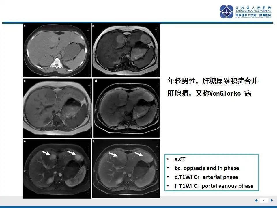 影像PPT - 【PPT】肝糖原累积症-21