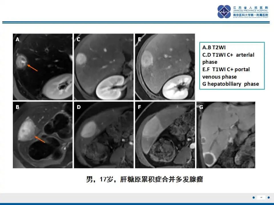 影像PPT - 【PPT】肝糖原累积症-22