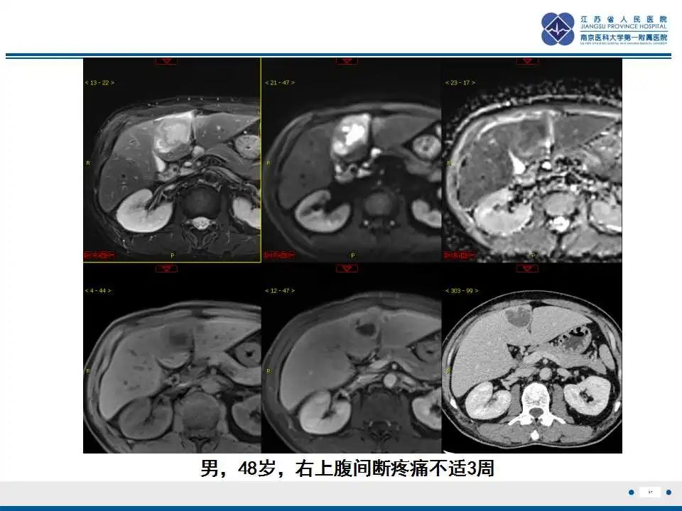 影像PPT - 【PPT】肝糖原累积症-27