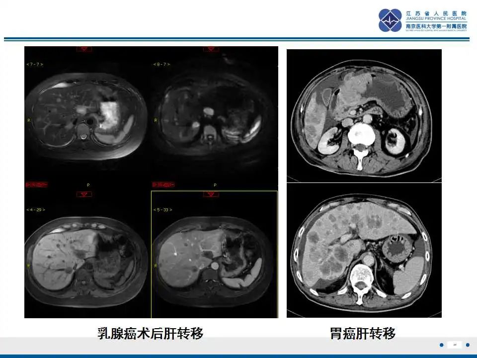 影像PPT - 【PPT】肝糖原累积症-29