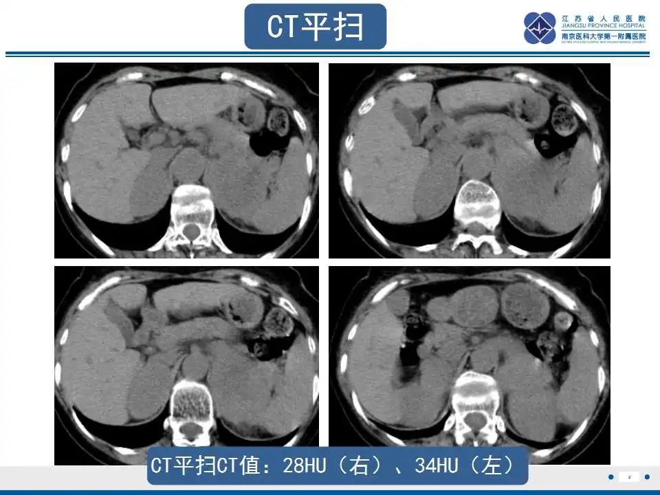影像PPT - 【PPT】原发性肾上腺淋巴瘤-3