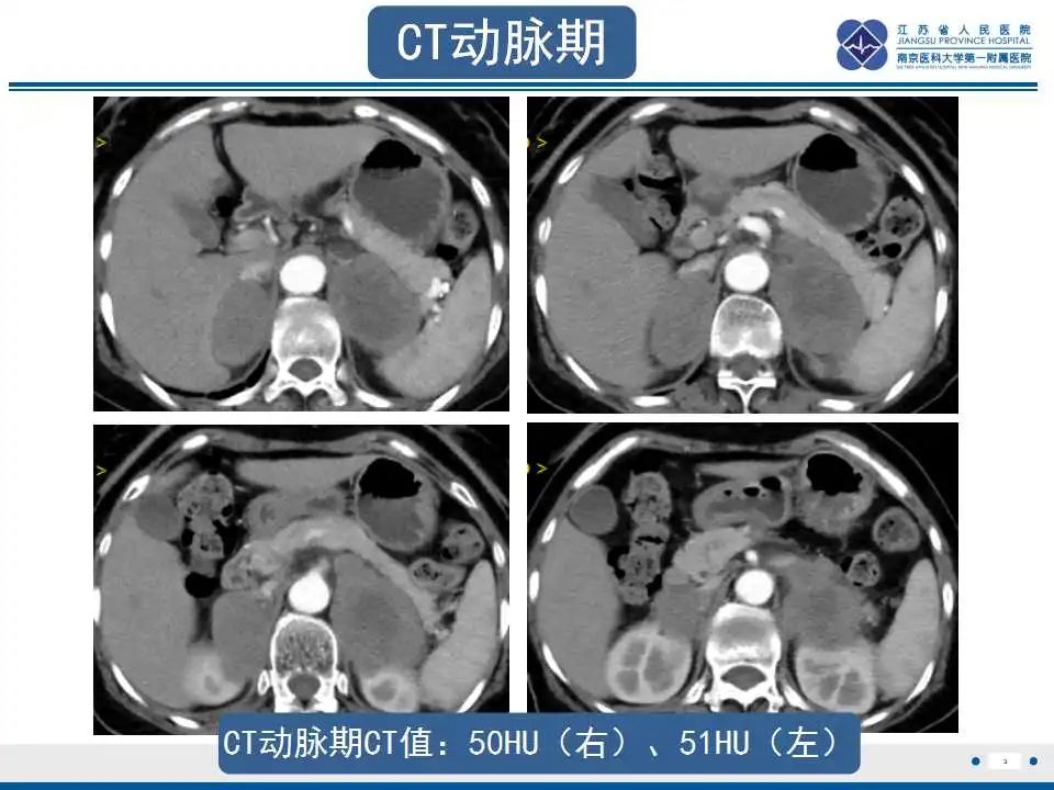 影像PPT - 【PPT】原发性肾上腺淋巴瘤-4