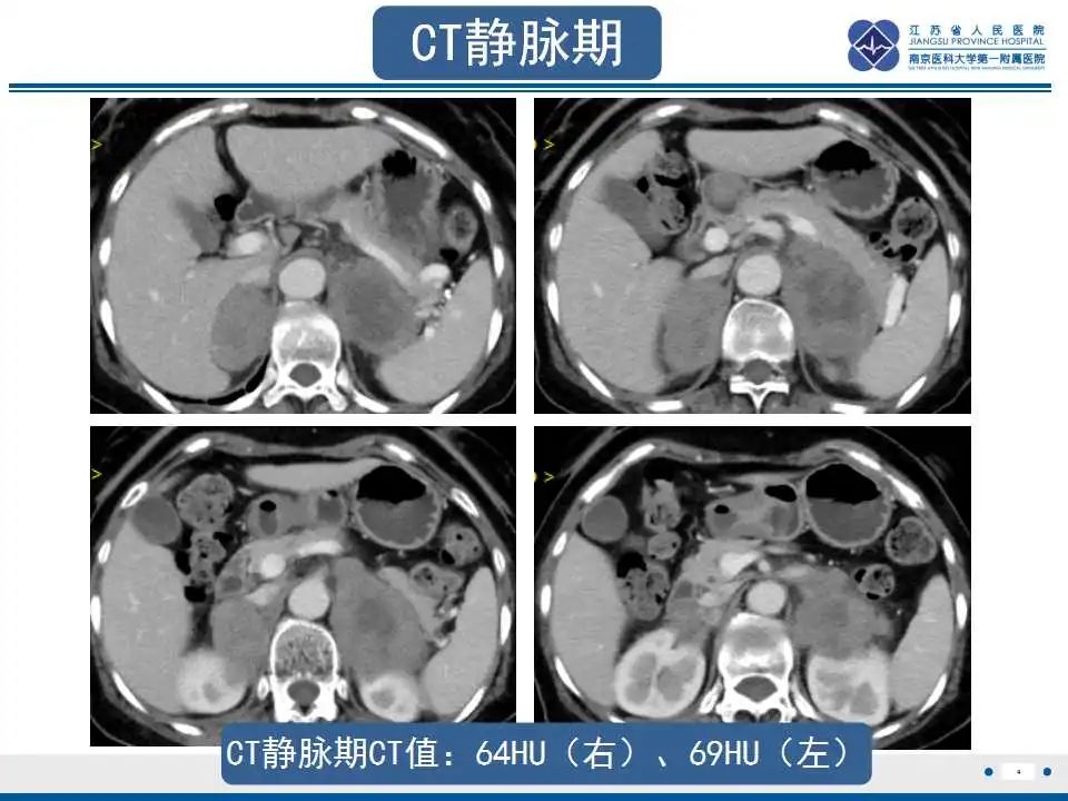 影像PPT - 【PPT】原发性肾上腺淋巴瘤-5