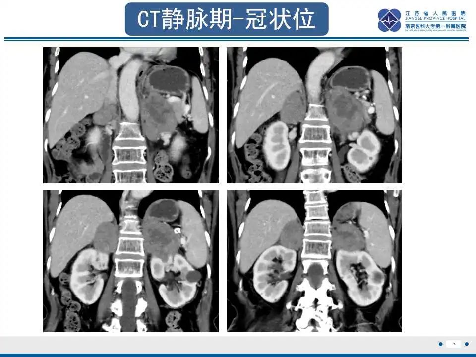 影像PPT - 【PPT】原发性肾上腺淋巴瘤-6
