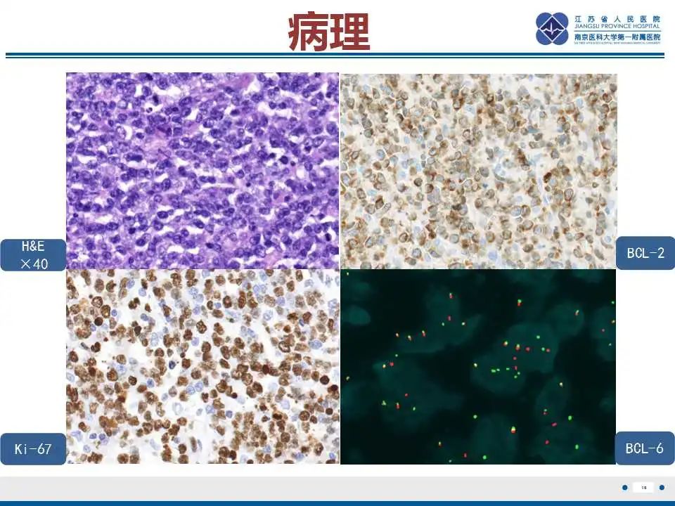 影像PPT - 【PPT】原发性肾上腺淋巴瘤-17