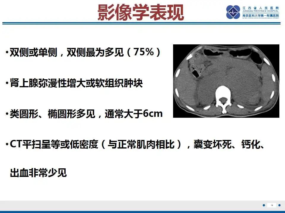 影像PPT - 【PPT】原发性肾上腺淋巴瘤-19