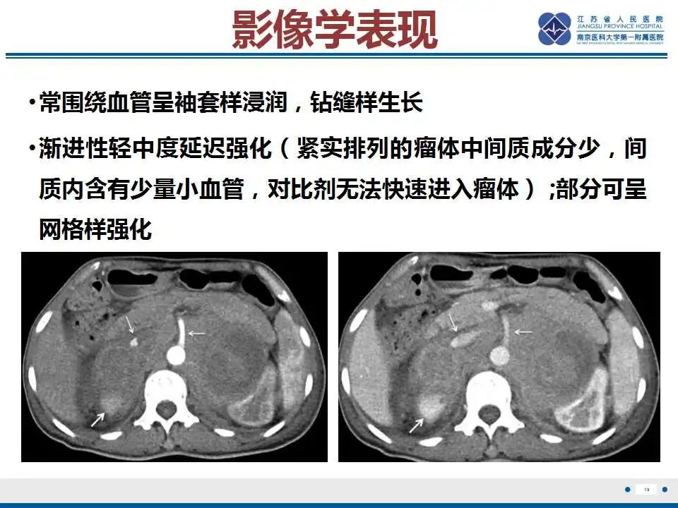 影像PPT - 【PPT】原发性肾上腺淋巴瘤-20