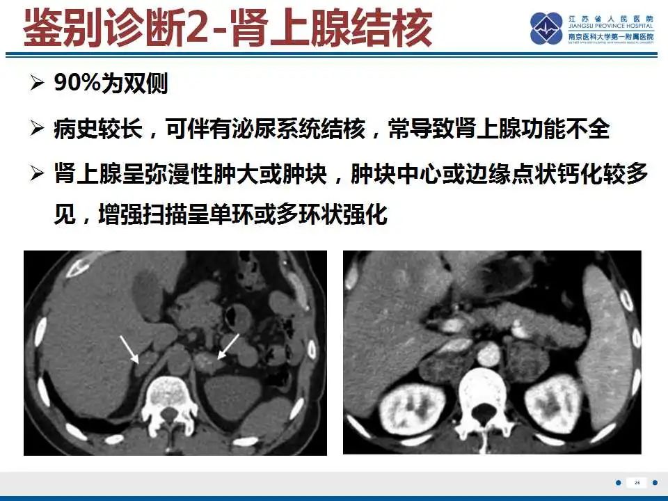 影像PPT - 【PPT】原发性肾上腺淋巴瘤-27
