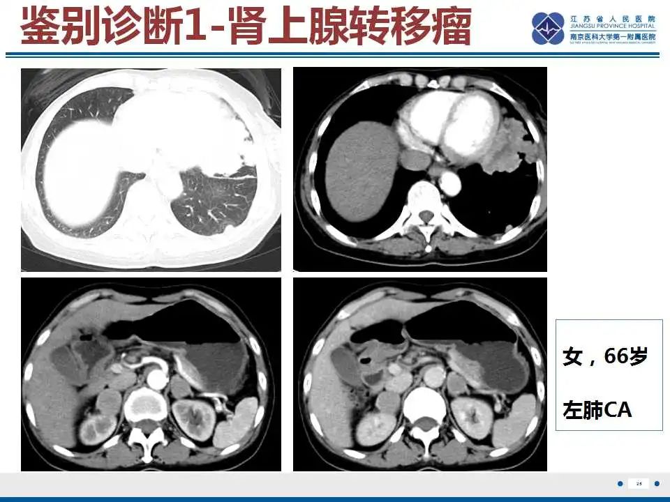 影像PPT - 【PPT】原发性肾上腺淋巴瘤-26