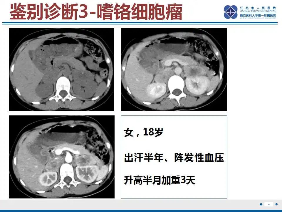 影像PPT - 【PPT】原发性肾上腺淋巴瘤-29