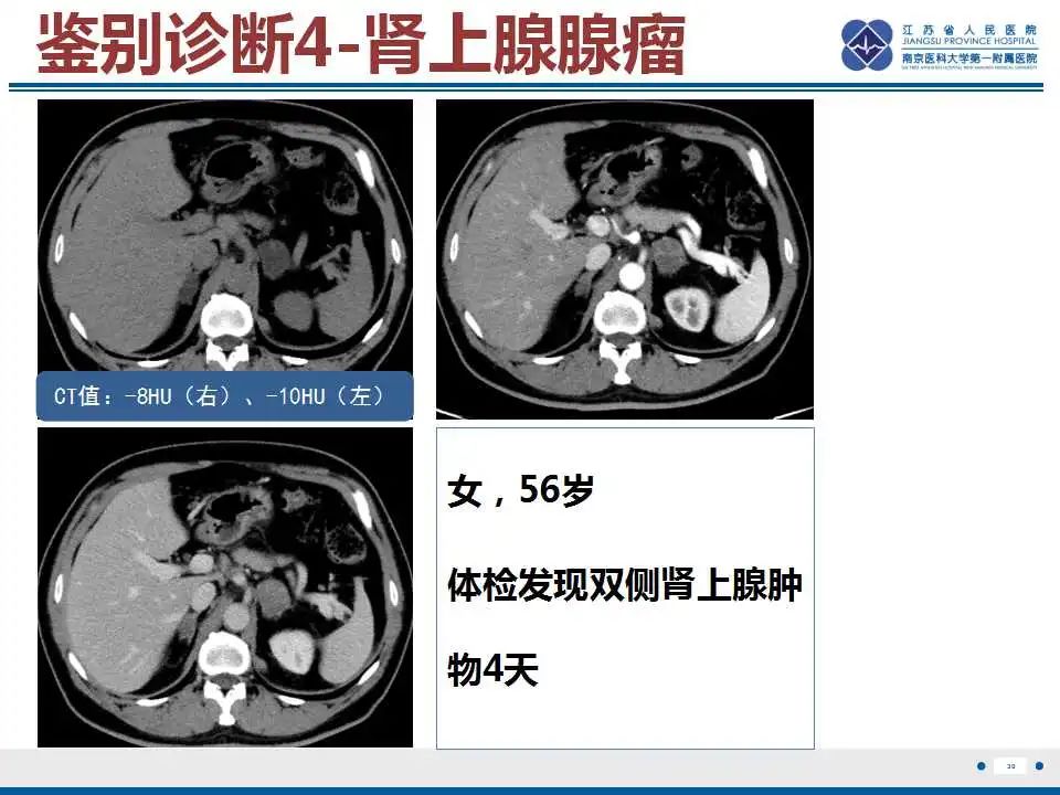 影像PPT - 【PPT】原发性肾上腺淋巴瘤-31