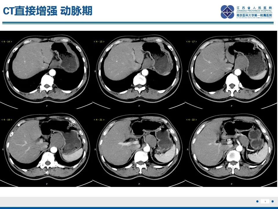 影像PPT - 【PPT】苗勒氏管囊肿-3