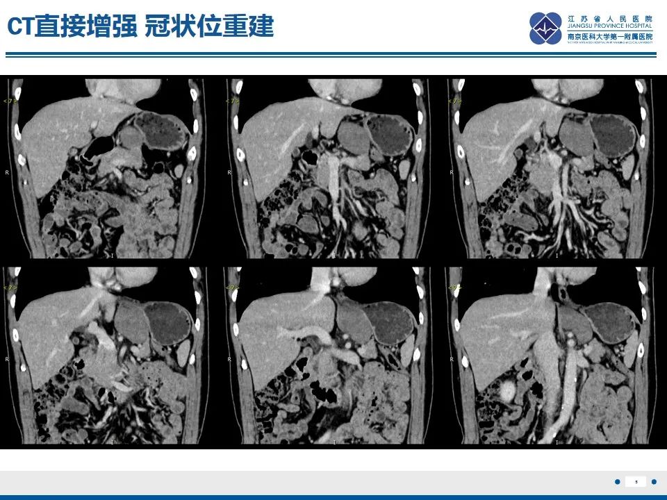 影像PPT - 【PPT】苗勒氏管囊肿-5