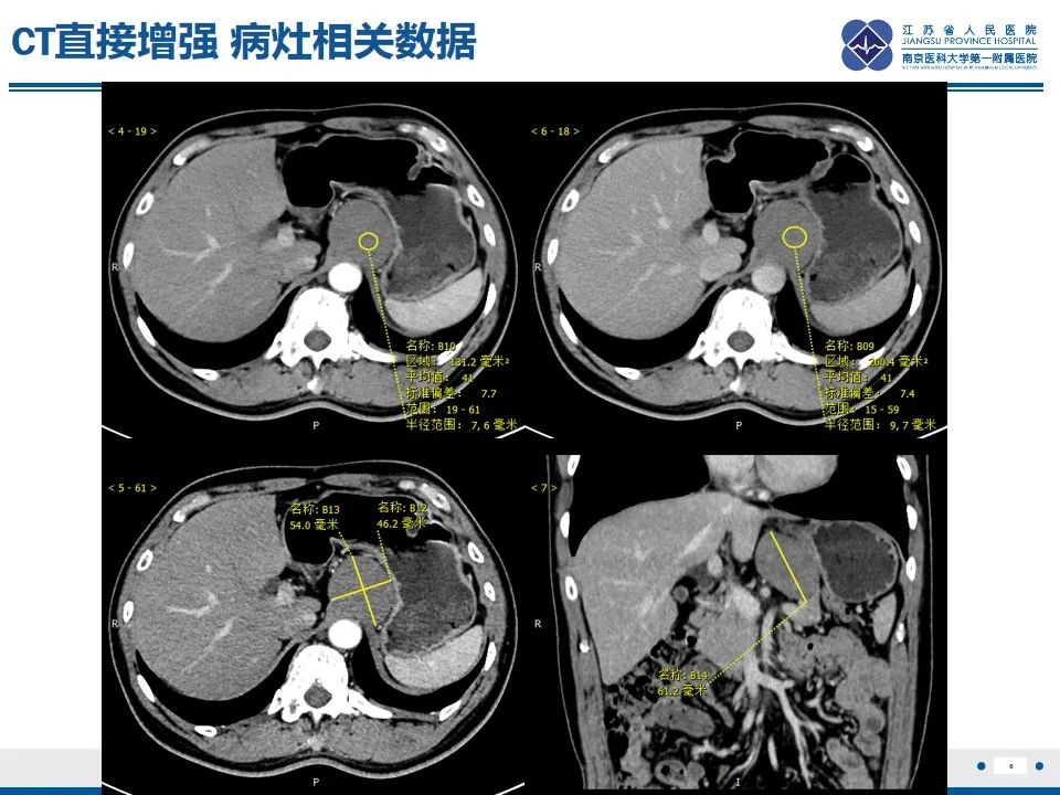 影像PPT - 【PPT】苗勒氏管囊肿-6