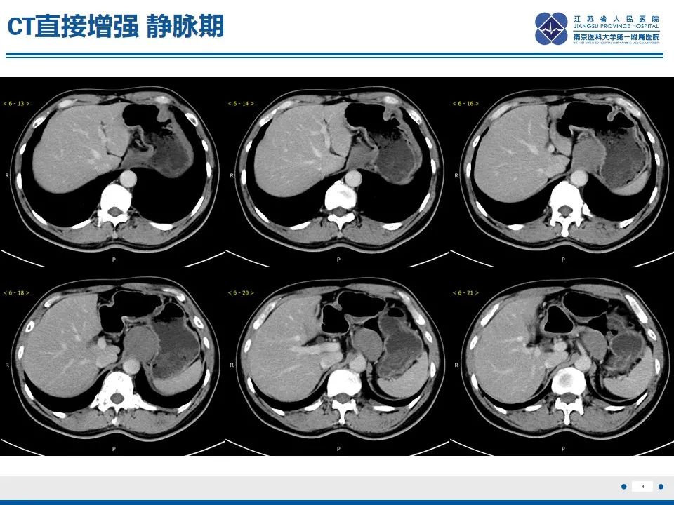 影像PPT - 【PPT】苗勒氏管囊肿-4