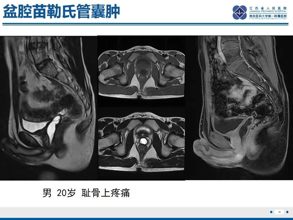 影像PPT - 【PPT】苗勒氏管囊肿-20