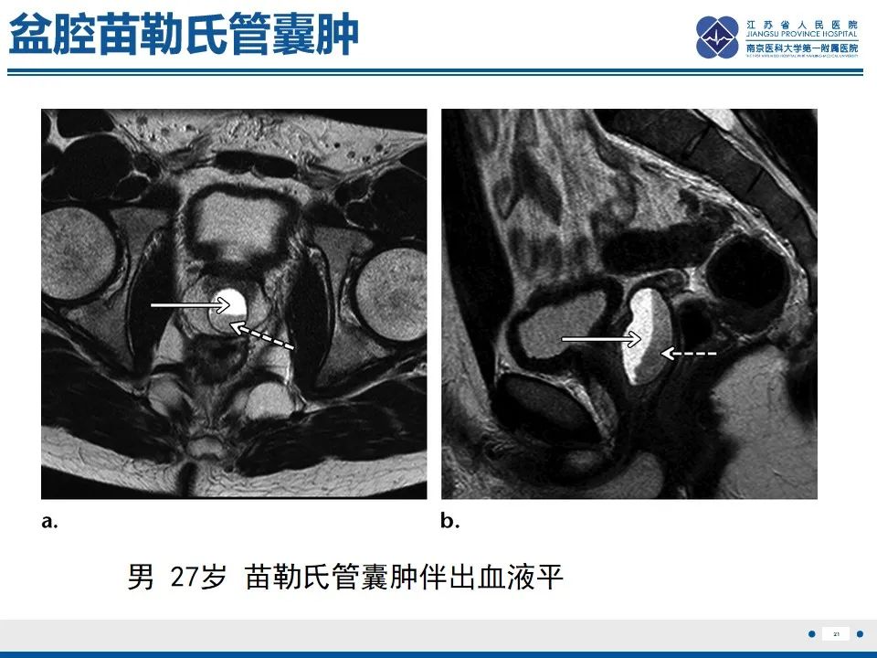 影像PPT - 【PPT】苗勒氏管囊肿-21