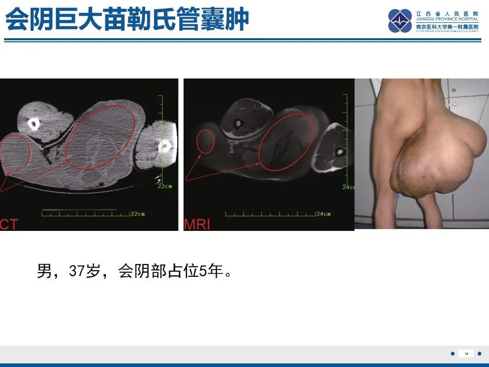 影像PPT - 【PPT】苗勒氏管囊肿-25