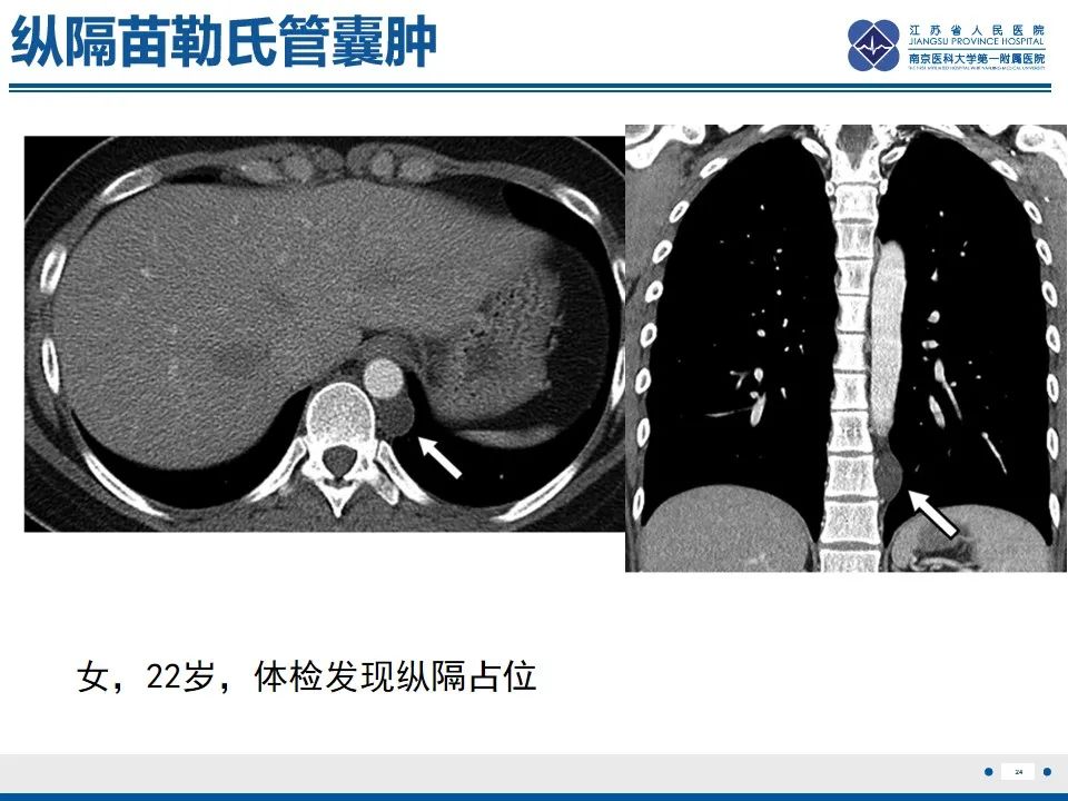 影像PPT - 【PPT】苗勒氏管囊肿-24