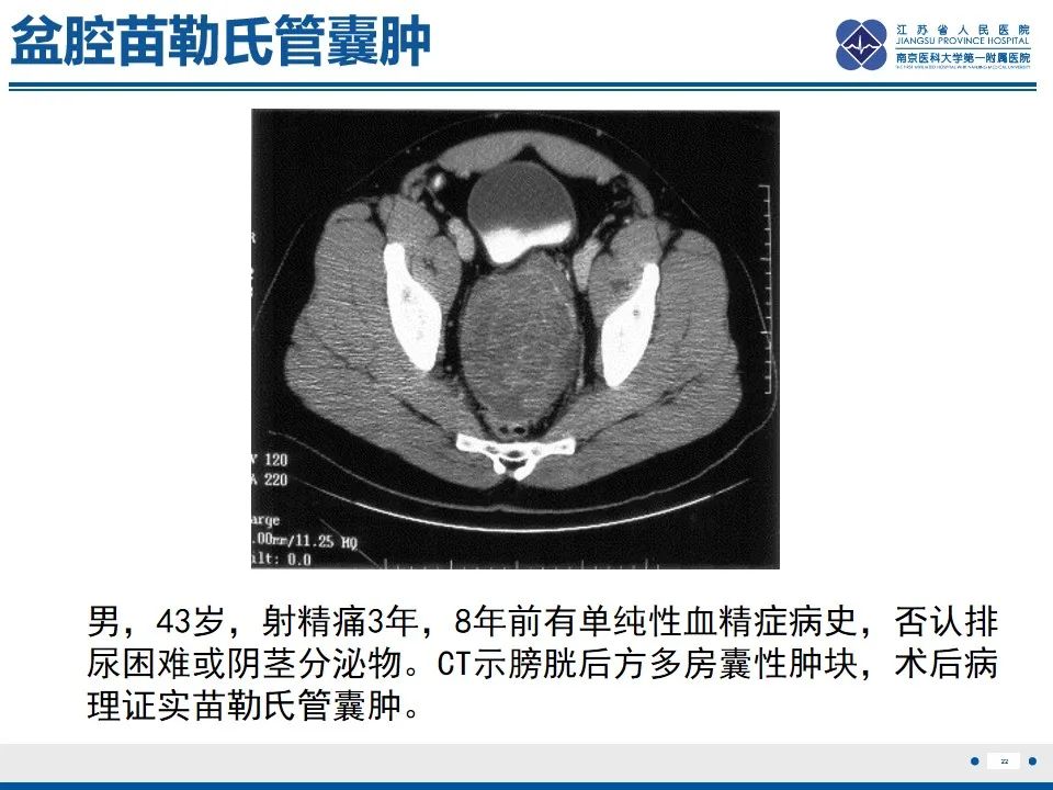 影像PPT - 【PPT】苗勒氏管囊肿-22