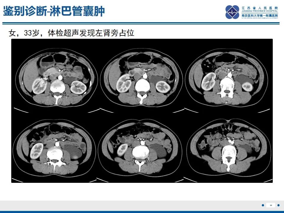 影像PPT - 【PPT】苗勒氏管囊肿-29