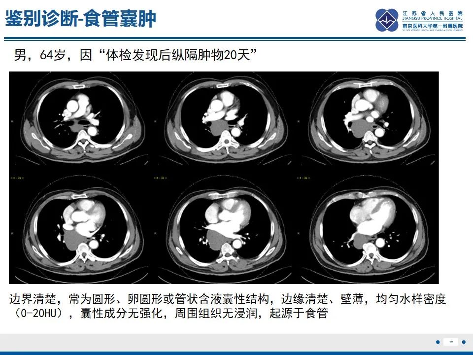 影像PPT - 【PPT】苗勒氏管囊肿-32