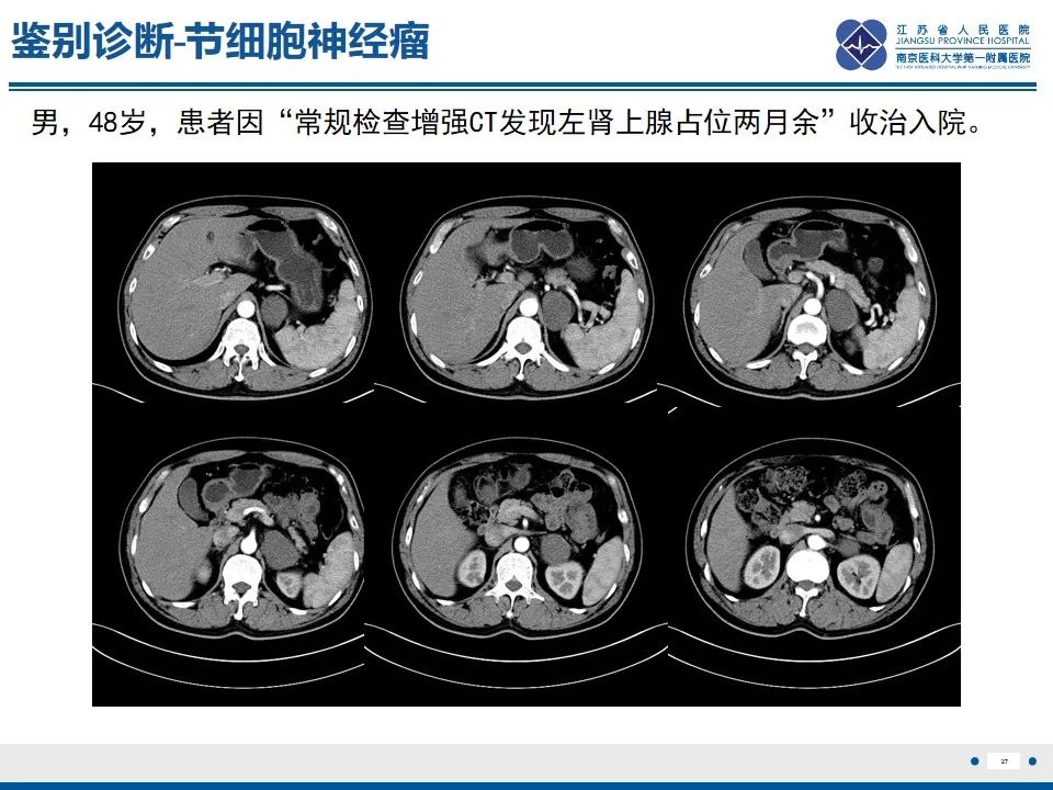 影像PPT - 【PPT】苗勒氏管囊肿-27