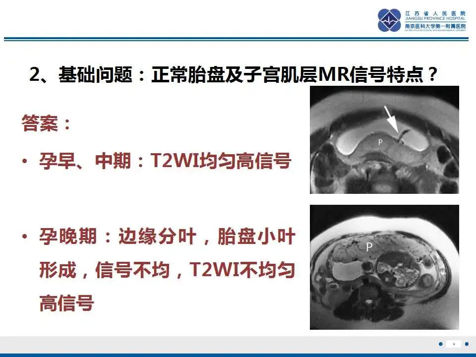 影像PPT - 【PPT】胎盘植入性疾病-10