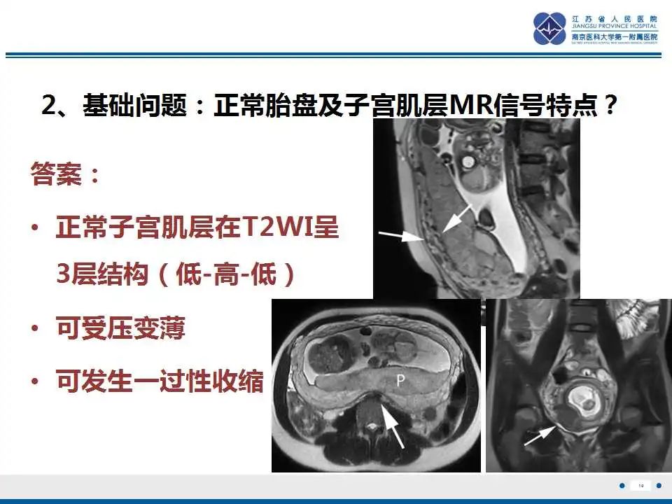 影像PPT - 【PPT】胎盘植入性疾病-11