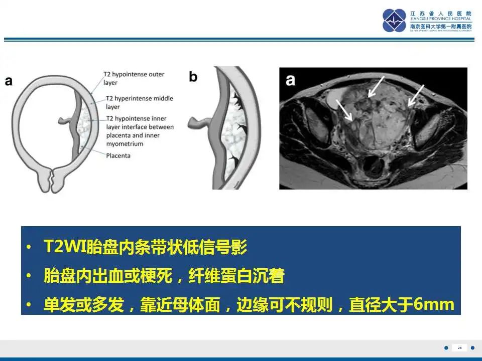 影像PPT - 【PPT】胎盘植入性疾病-27