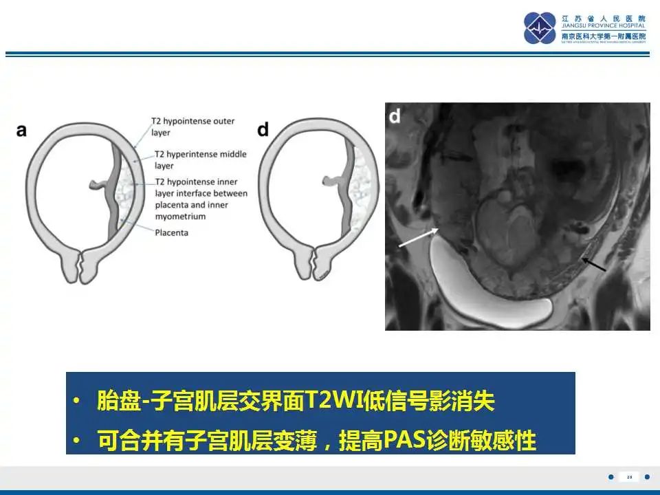 影像PPT - 【PPT】胎盘植入性疾病-29