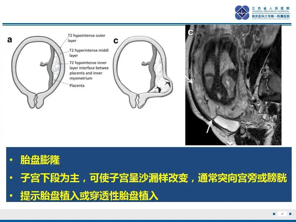 影像PPT - 【PPT】胎盘植入性疾病-28