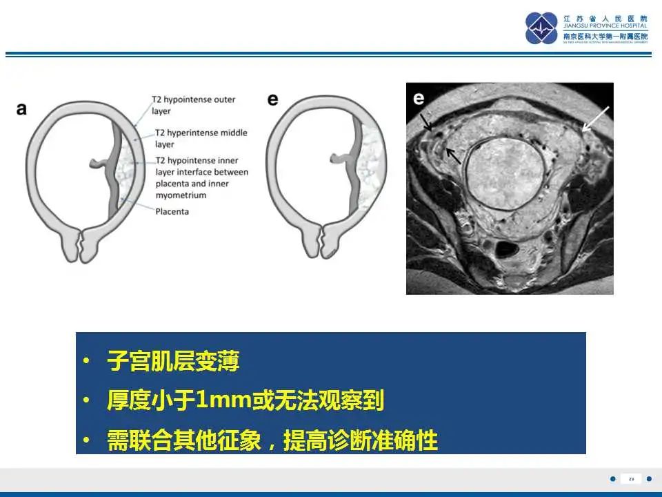 影像PPT - 【PPT】胎盘植入性疾病-30