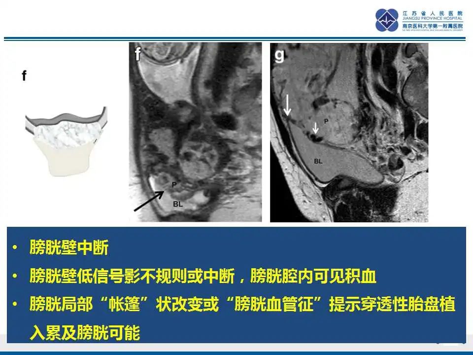 影像PPT - 【PPT】胎盘植入性疾病-31
