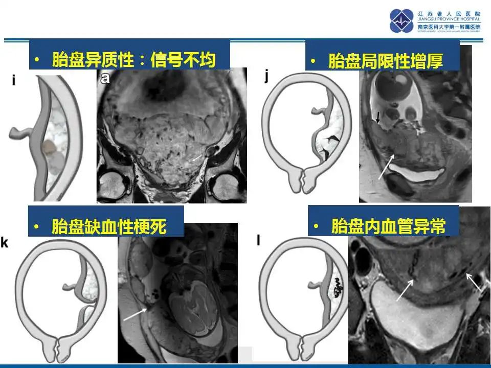 影像PPT - 【PPT】胎盘植入性疾病-34