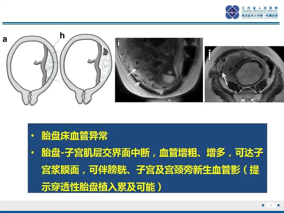 影像PPT - 【PPT】胎盘植入性疾病-32