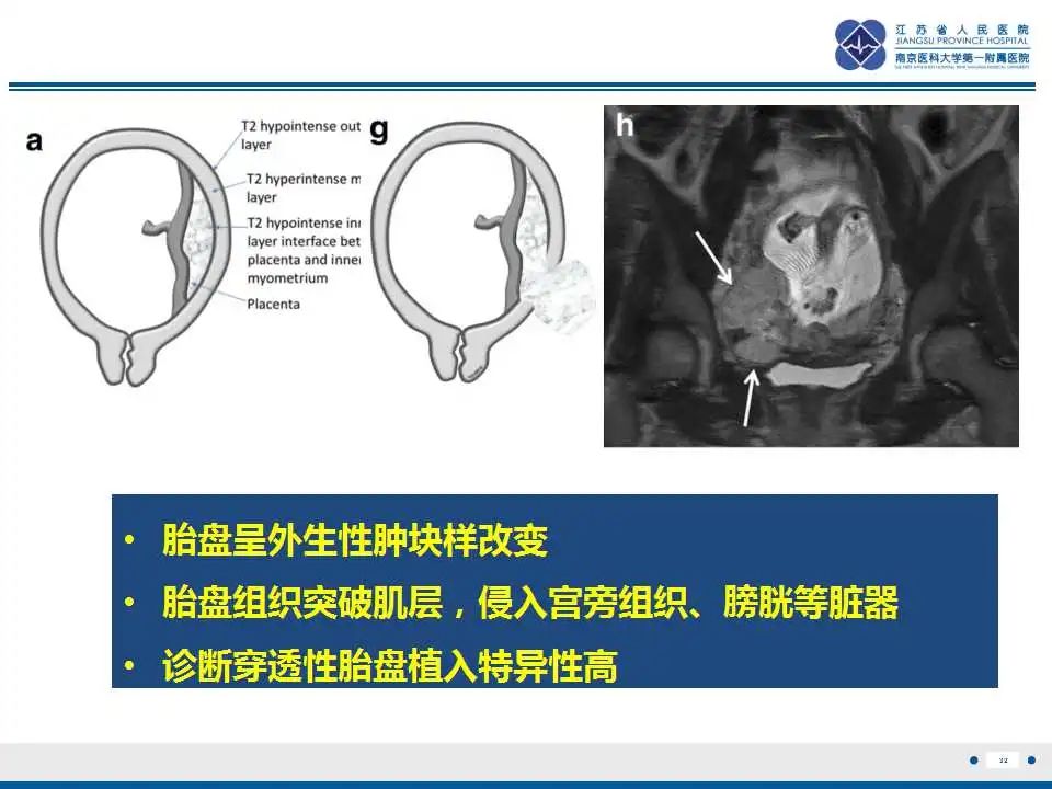 影像PPT - 【PPT】胎盘植入性疾病-33