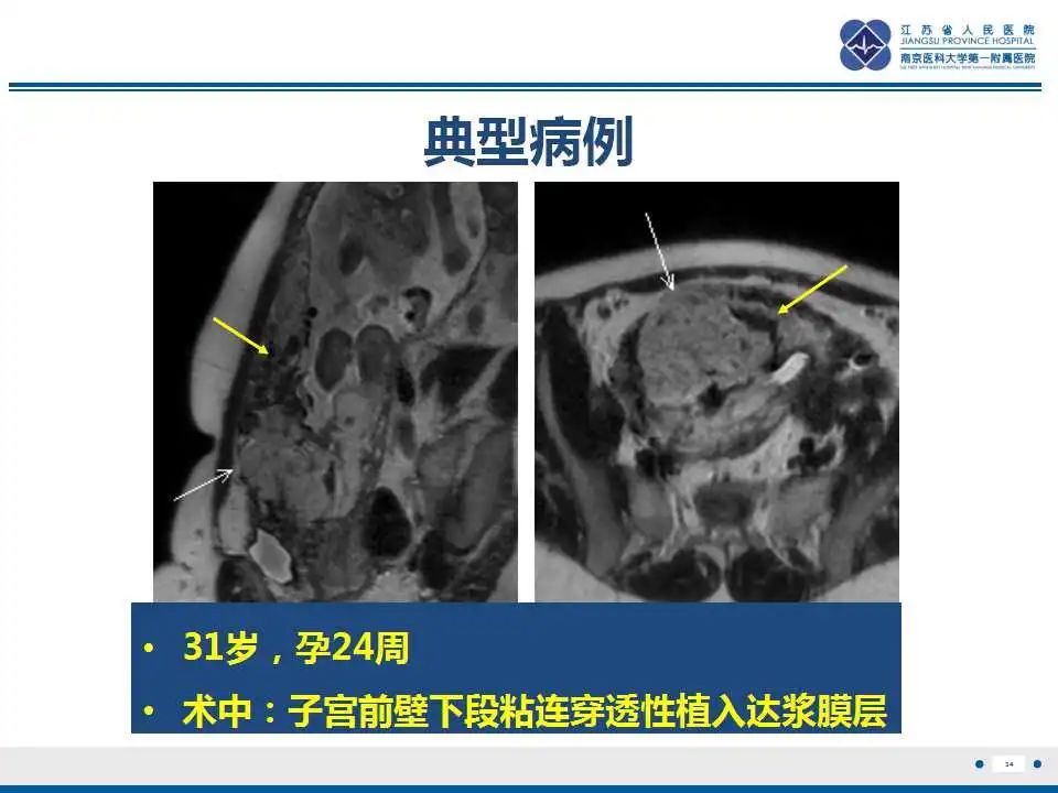 影像PPT - 【PPT】胎盘植入性疾病-35