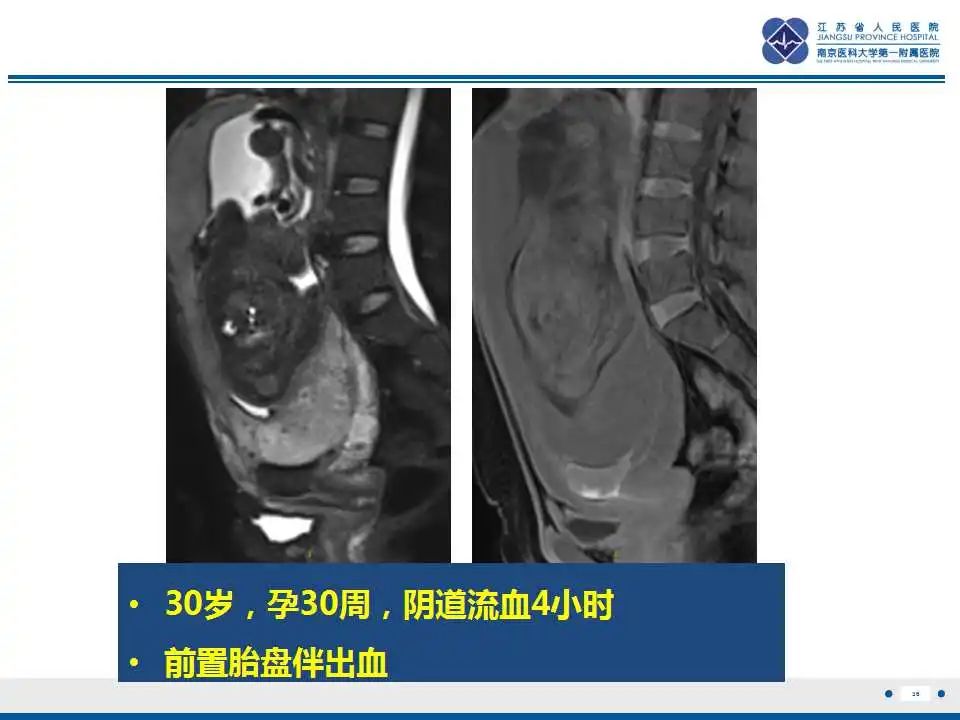 影像PPT - 【PPT】胎盘植入性疾病-37