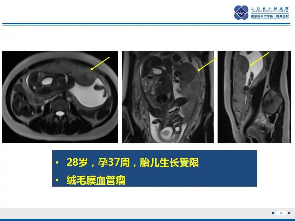 影像PPT - 【PPT】胎盘植入性疾病-39