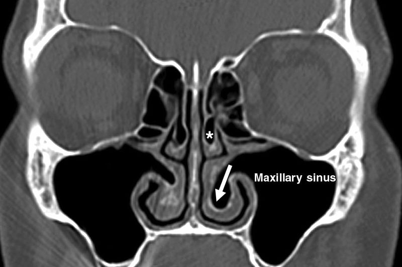 影像PPT - 鼻窦和鼻腔解剖变异的CT-1 影像PPT - 鼻窦和鼻腔解剖变异的CT-1