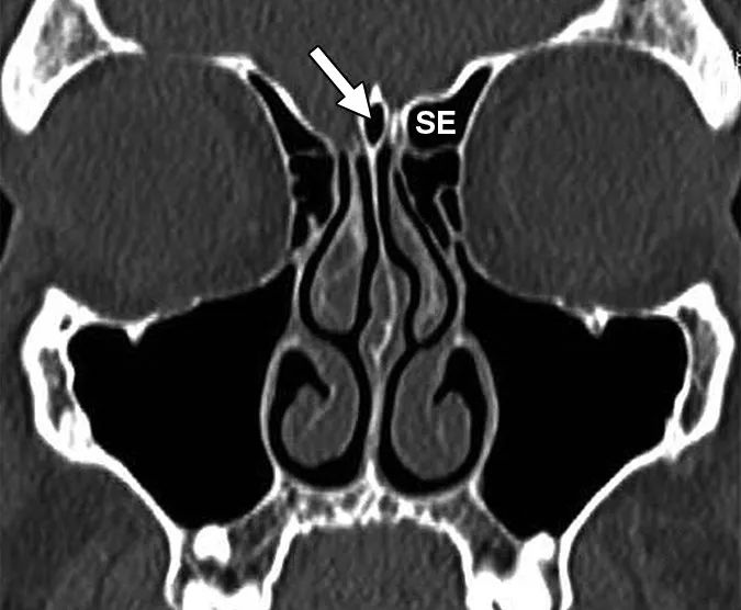 影像PPT - 鼻窦和鼻腔解剖变异的CT-2 影像PPT - 鼻窦和鼻腔解剖变异的CT-2
