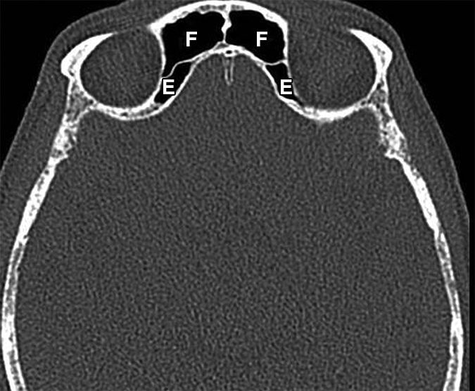 影像PPT - 鼻窦和鼻腔解剖变异的CT-3 影像PPT - 鼻窦和鼻腔解剖变异的CT-3