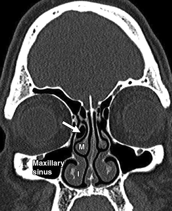 影像PPT - 鼻窦和鼻腔解剖变异的CT-5 影像PPT - 鼻窦和鼻腔解剖变异的CT-5