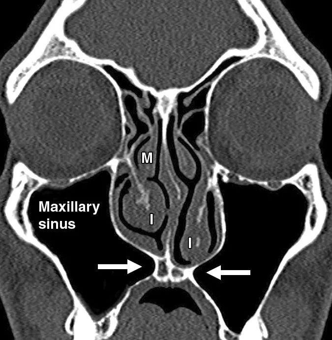 影像PPT - 鼻窦和鼻腔解剖变异的CT-6 影像PPT - 鼻窦和鼻腔解剖变异的CT-6