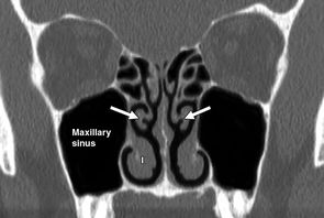 影像PPT - 鼻窦和鼻腔解剖变异的CT-7 影像PPT - 鼻窦和鼻腔解剖变异的CT-7