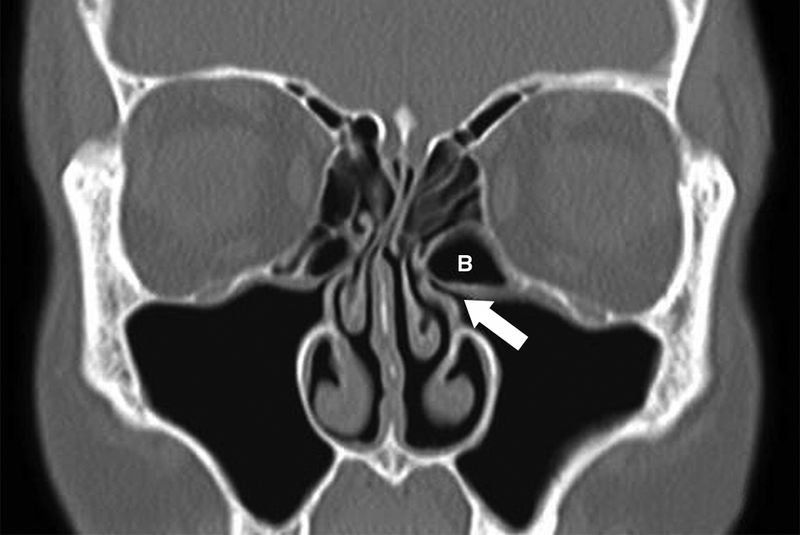 影像PPT - 鼻窦和鼻腔解剖变异的CT-9 影像PPT - 鼻窦和鼻腔解剖变异的CT-9
