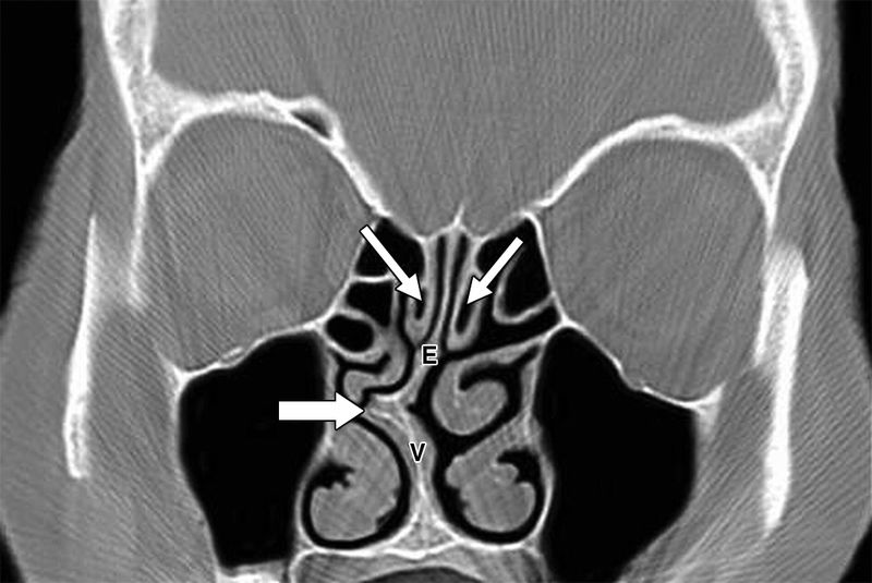 影像PPT - 鼻窦和鼻腔解剖变异的CT-8 影像PPT - 鼻窦和鼻腔解剖变异的CT-8