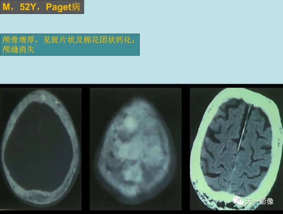 影像PPT - 【PPT】颅骨畸形性骨炎-3