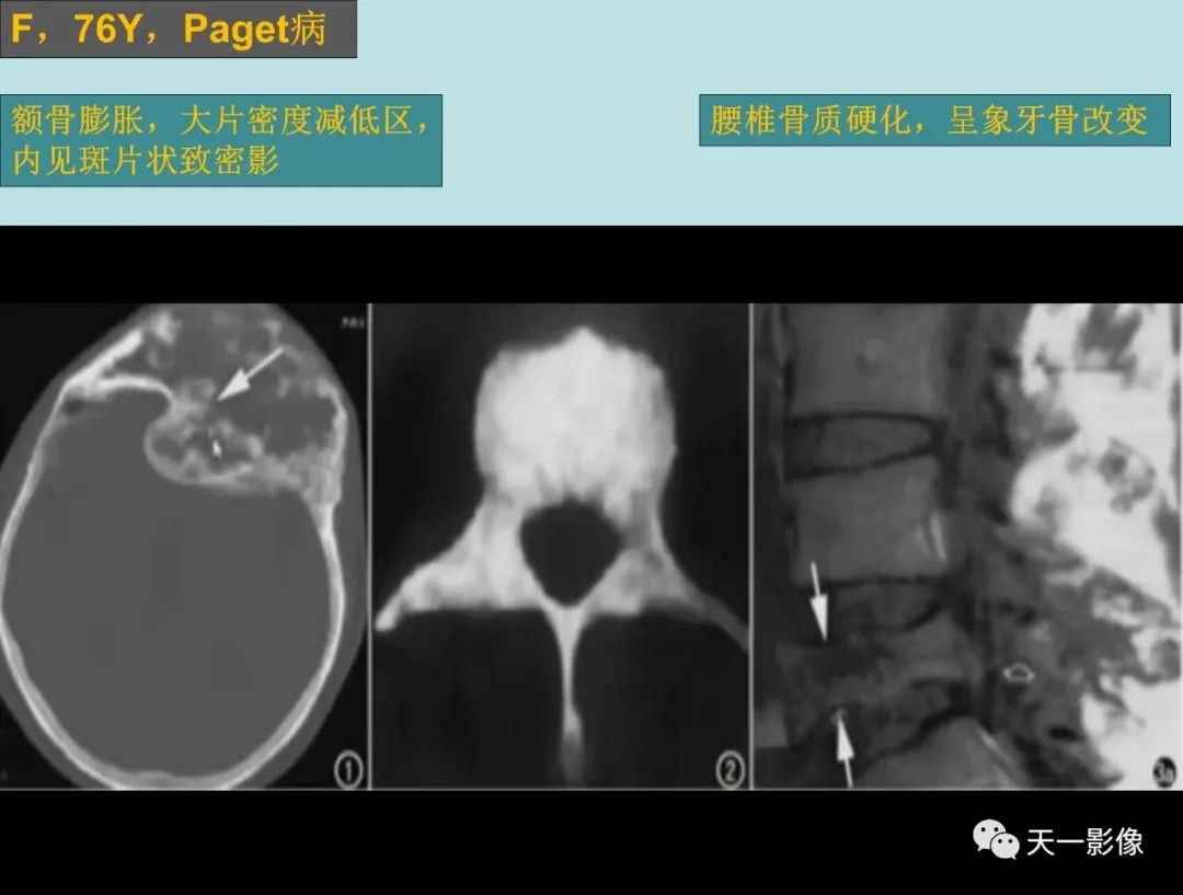 影像PPT - 【PPT】颅骨畸形性骨炎-4